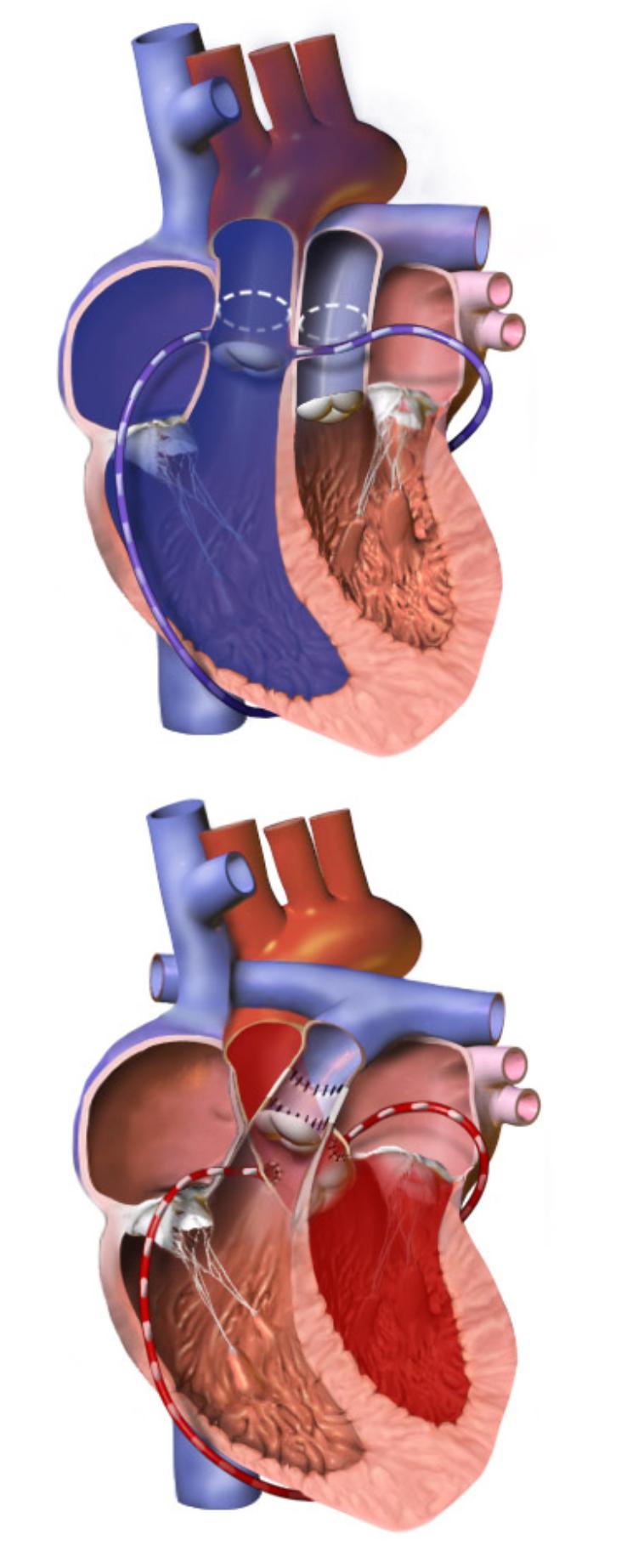 Understanding the Arterial Switch Operation: Correcting Transposition of the Great Arteries