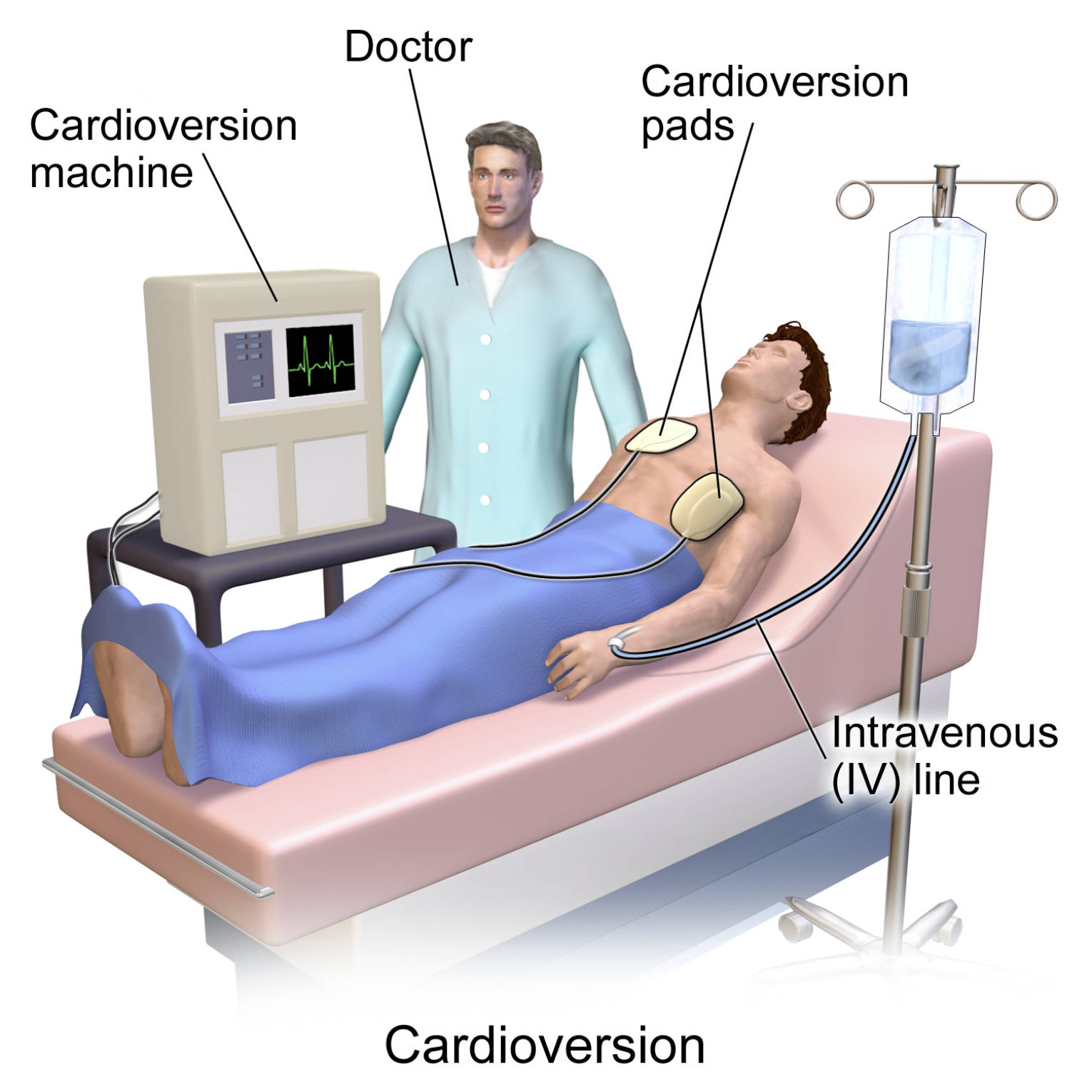 Cardioversion: Restoring Normal Heart Rhythm