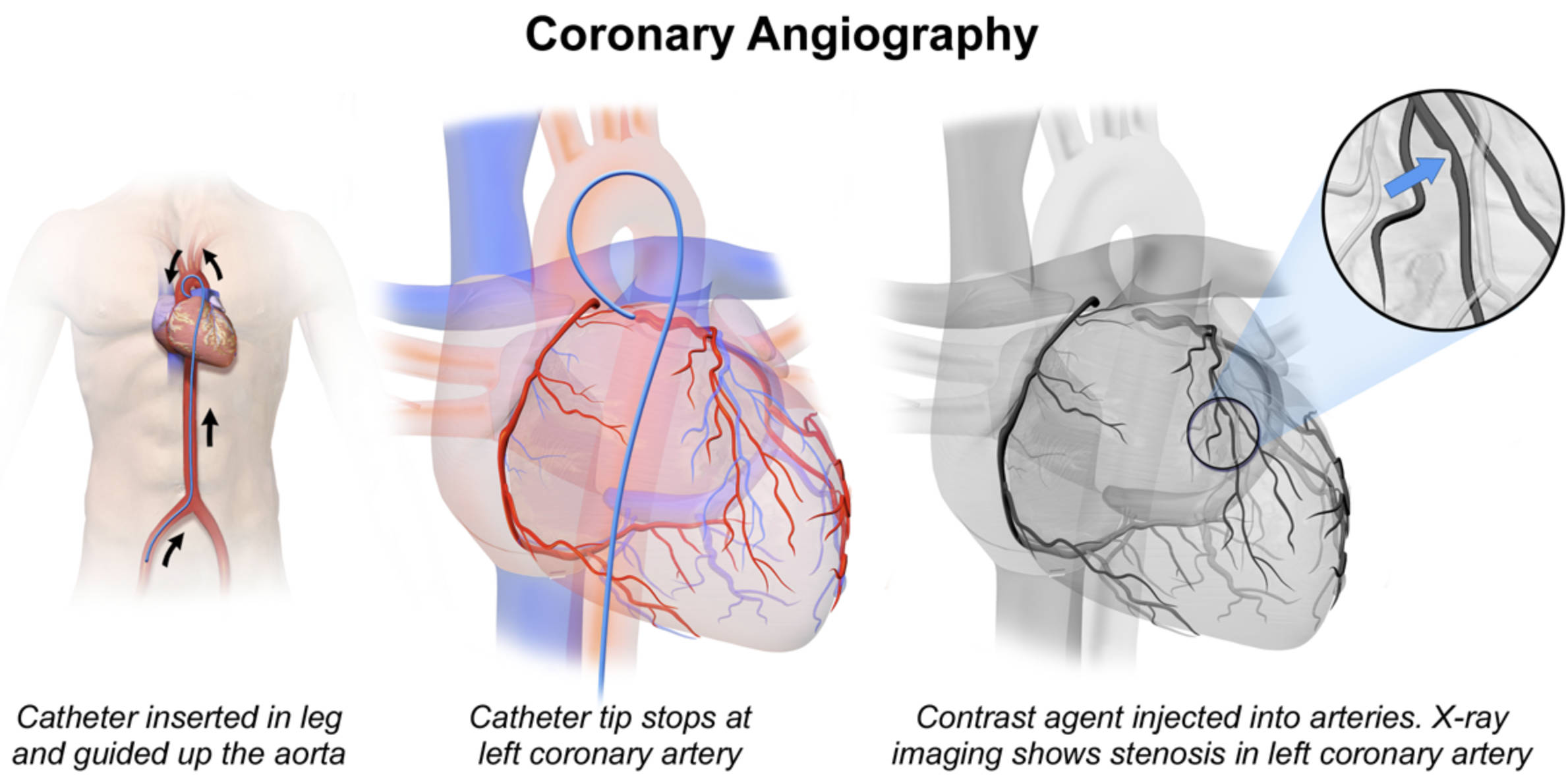 Coronary Angiography Explained: Diagnosing Arterial Blockages