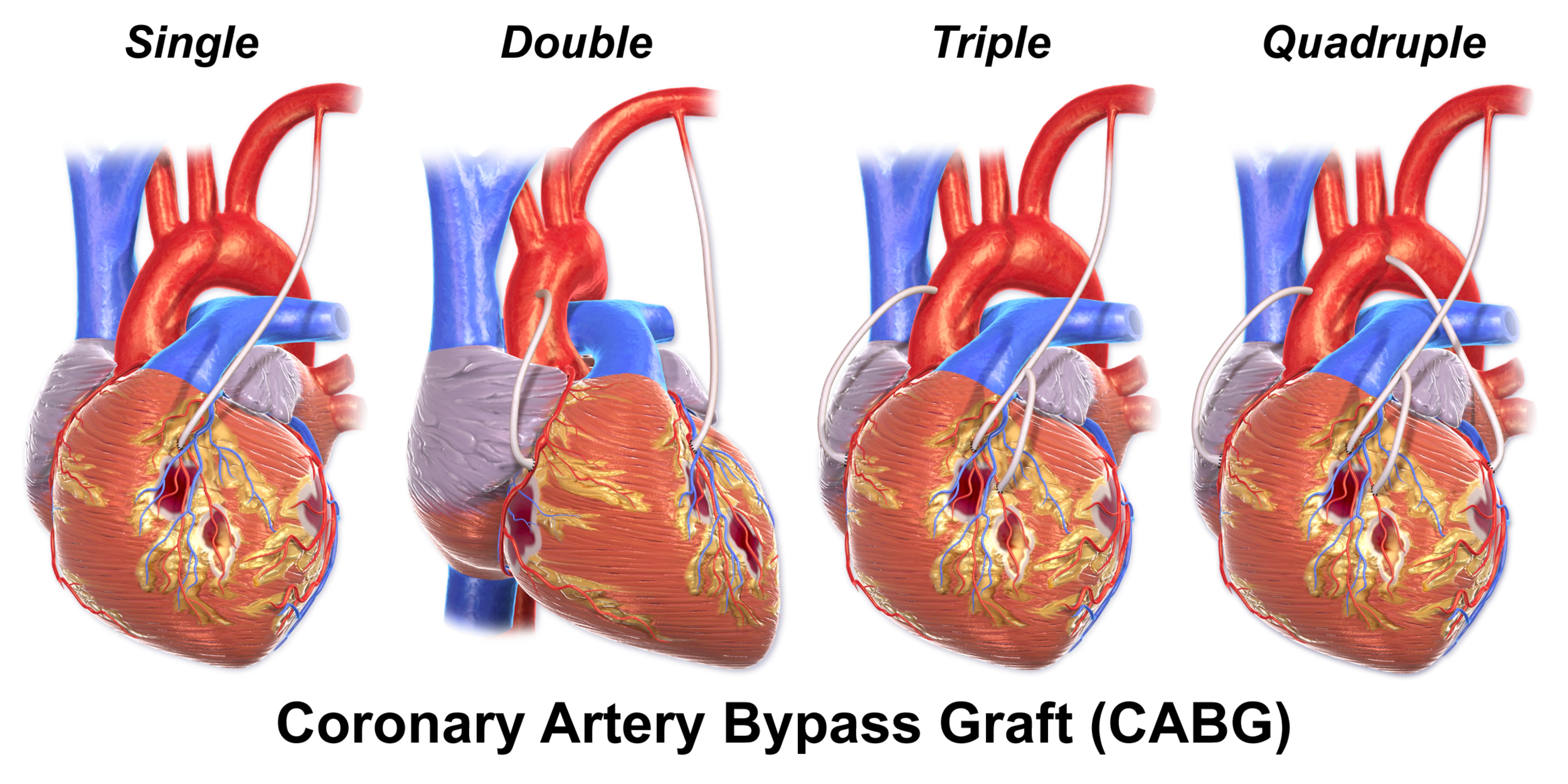 Coronary Artery Bypass Graft (CABG) Options: Single to Quadruple Bypasses