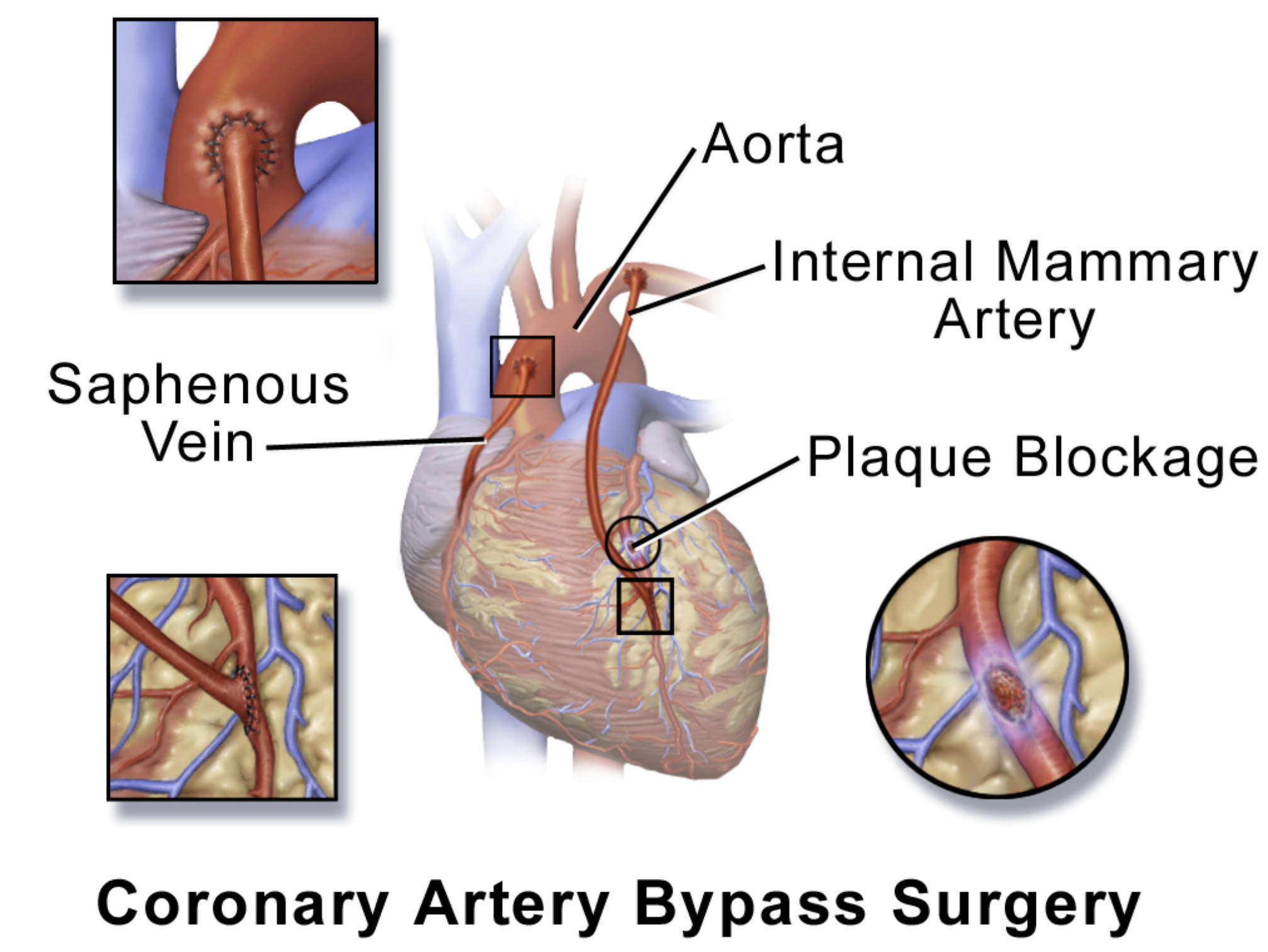 Coronary Artery Bypass Graft (CABG): Restoring Blood Flow to the Heart
