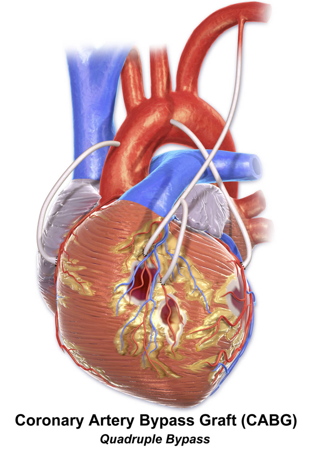 Quadruple Bypass CABG: Extensive Revascularization for Severe CAD