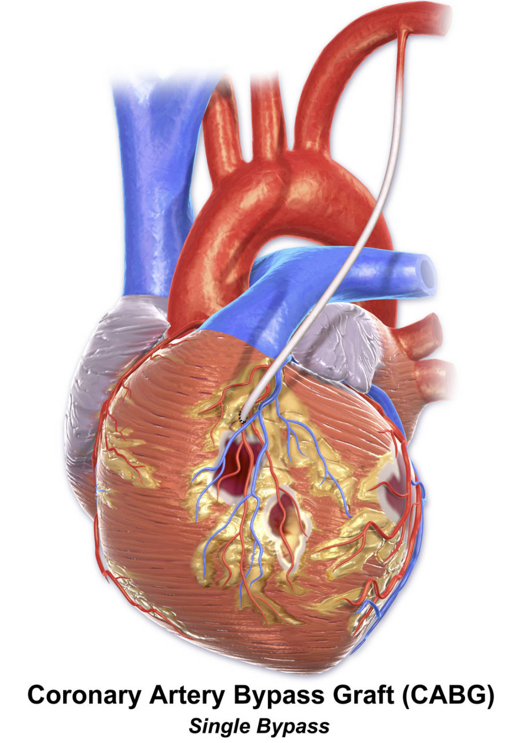 Single Bypass CABG: Targeted Revascularization for Coronary Artery Disease