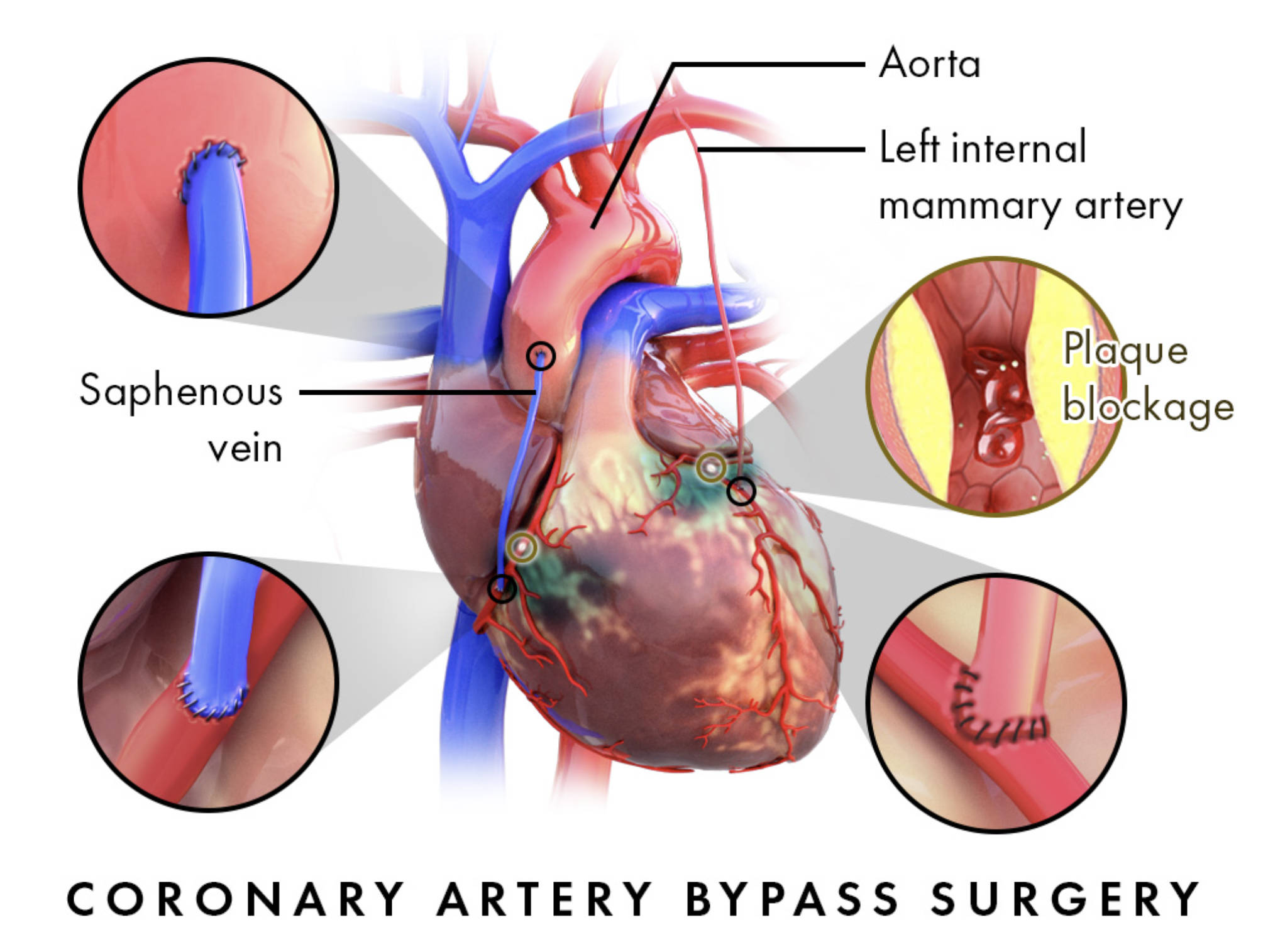 Understanding Coronary Artery Bypass Graft (CABG) Surgery