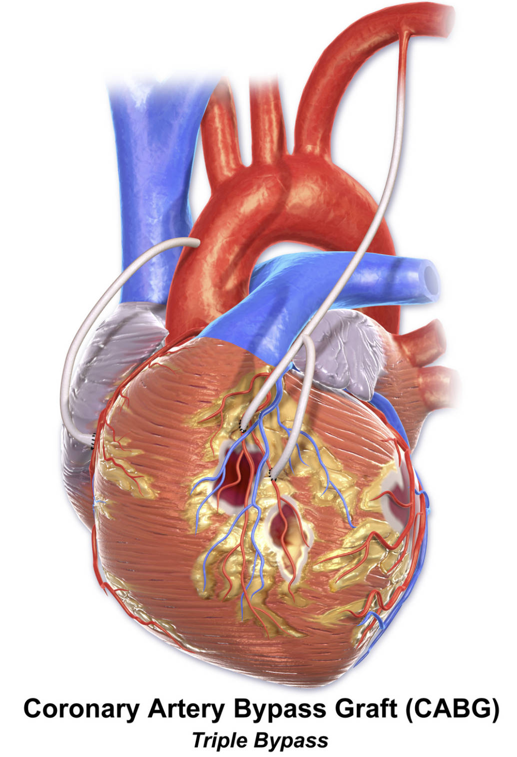 Triple Bypass CABG: Comprehensive Revascularization for Extensive CAD
