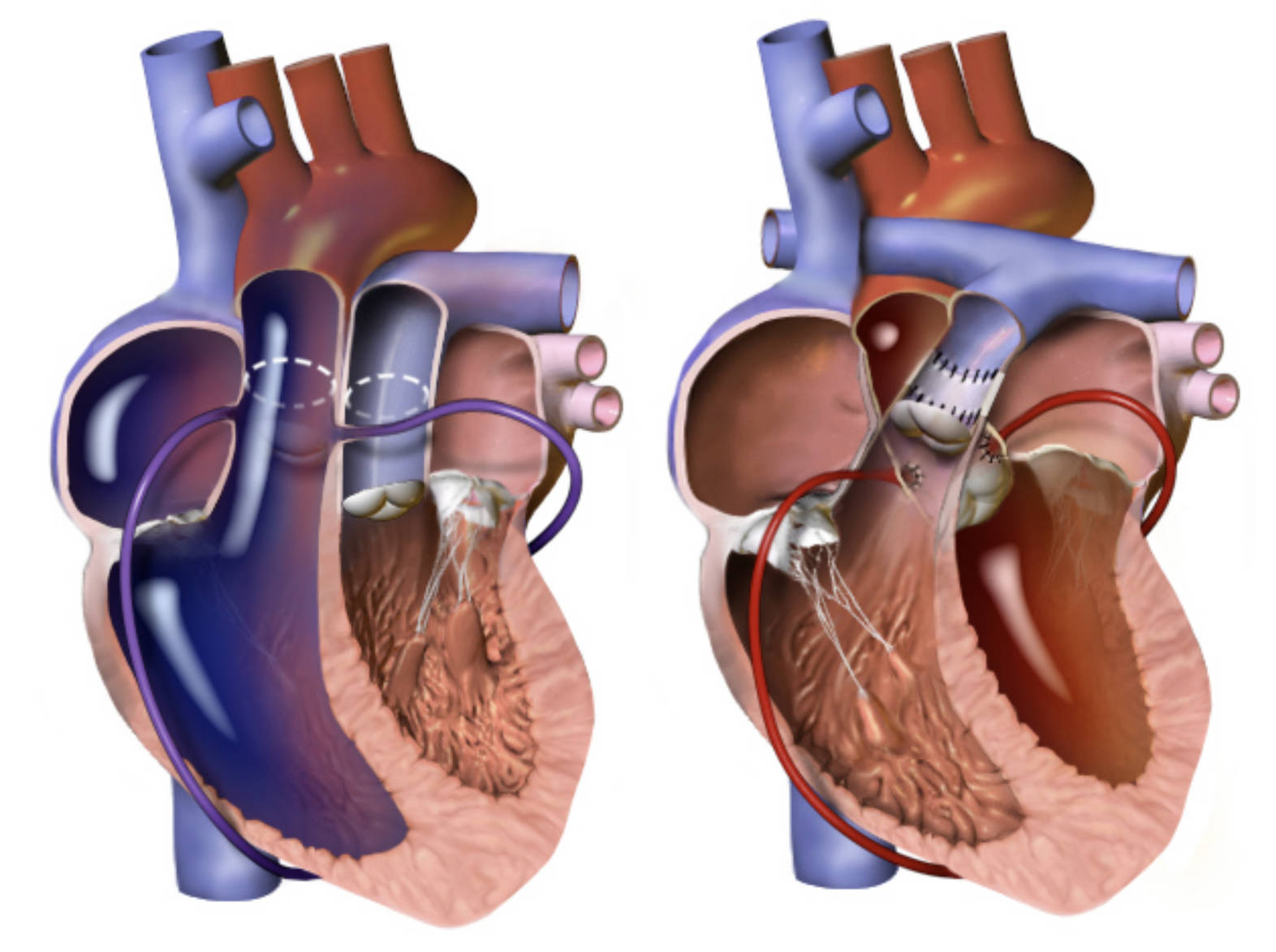 The Arterial Switch Operation: Correcting Transposition of the Great Arteries