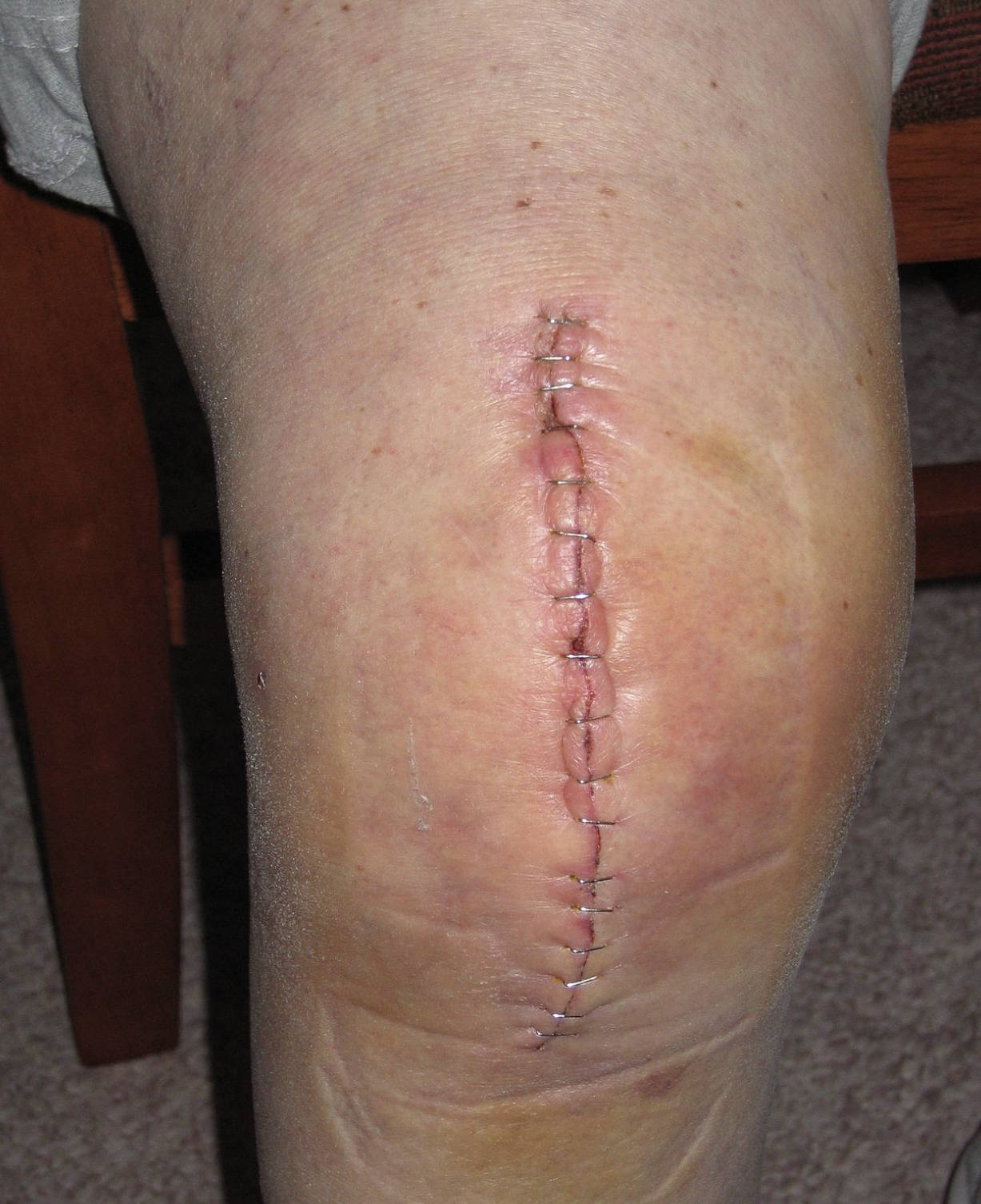 Surgical Wound Healing: Understanding Knee Replacement Incisions and Staple Closure