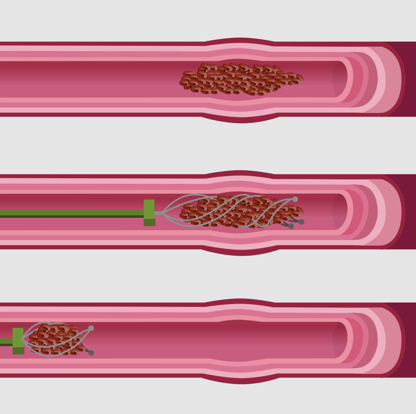 Mechanical Thrombectomy: The Science of Stent Retrievers in Ischemic Stroke Treatment